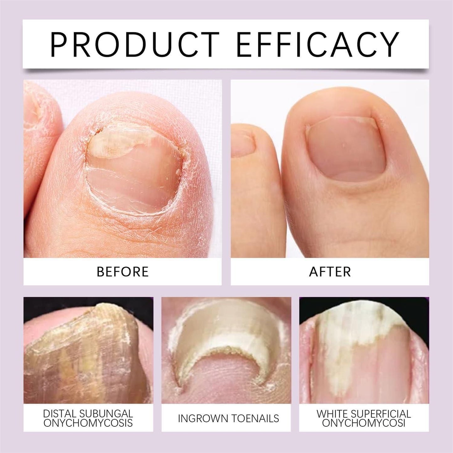 Nail Growth & Repair Serum (BUY 1 GET 1 FREE)